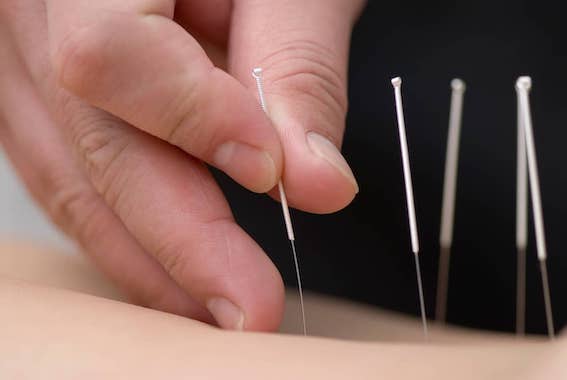 Acupuncture Aurora Acupuncture Aurora