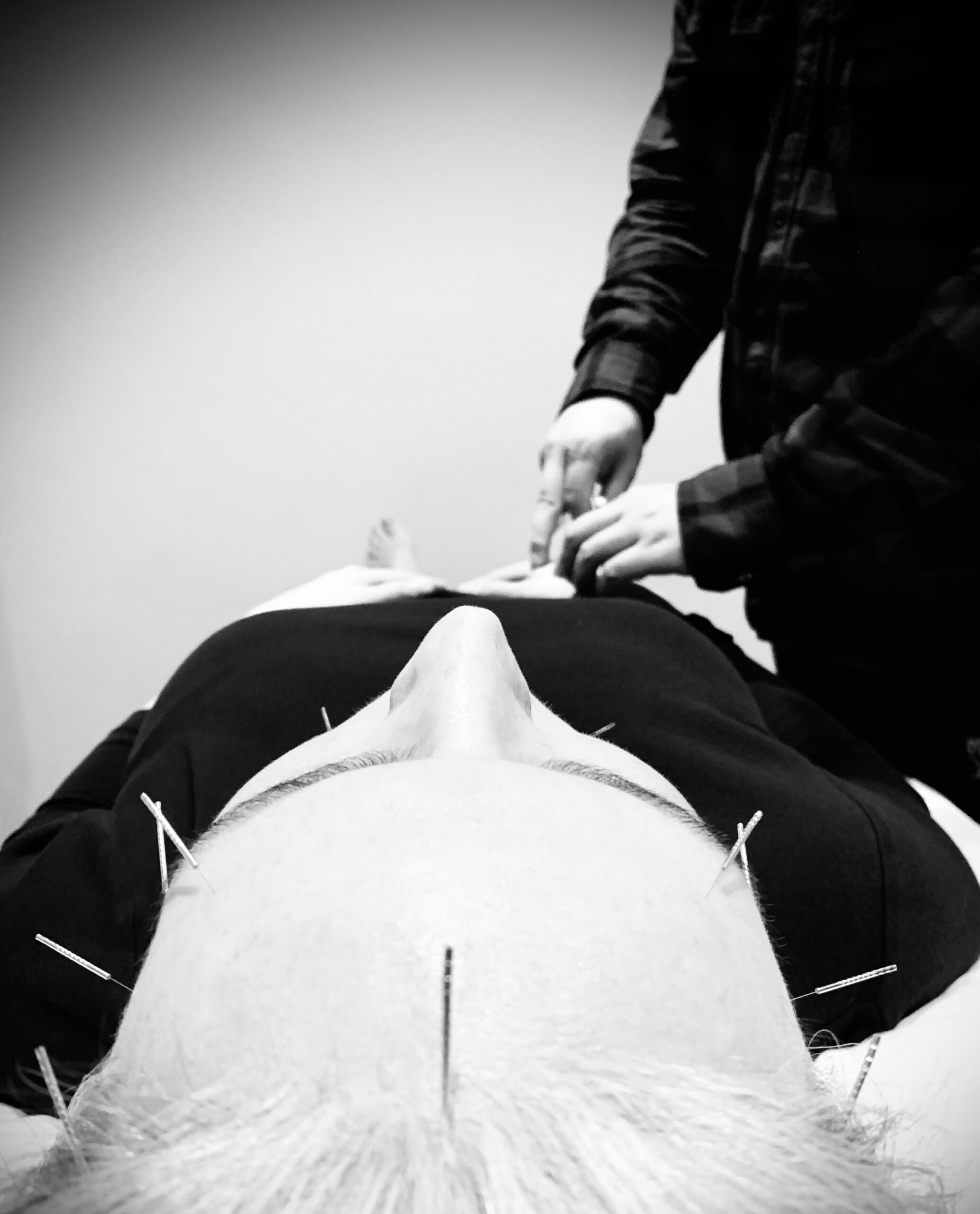 Cosmetic Acupuncture