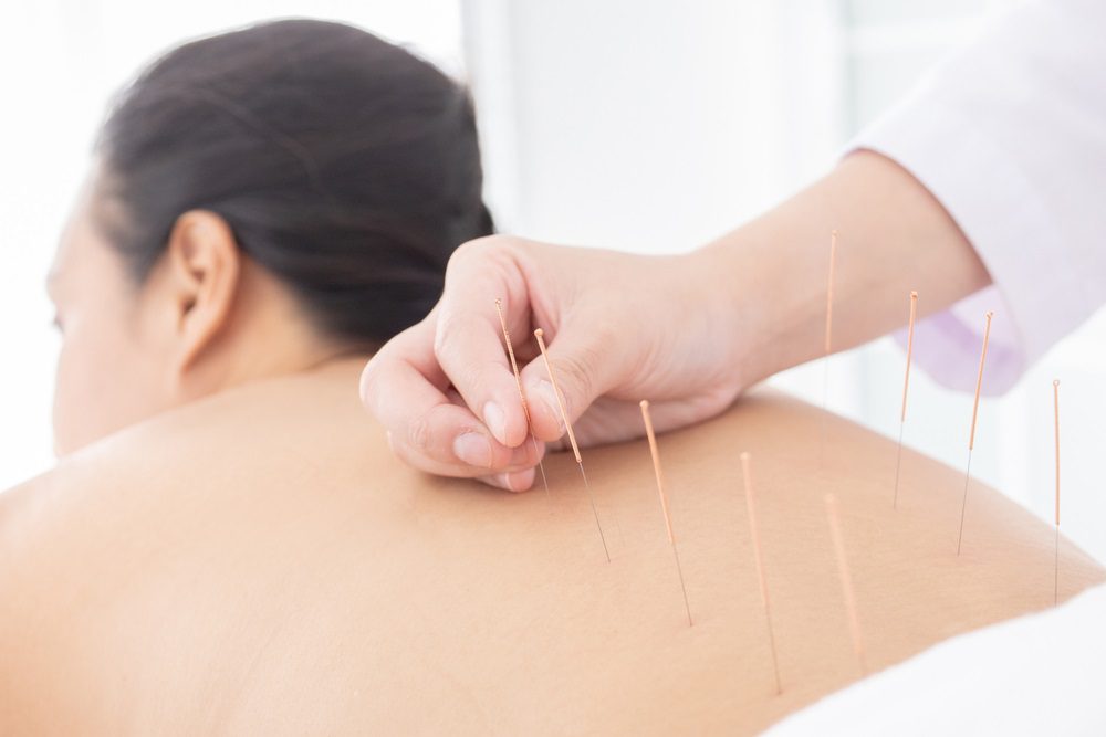 Acupuncture in Aurora