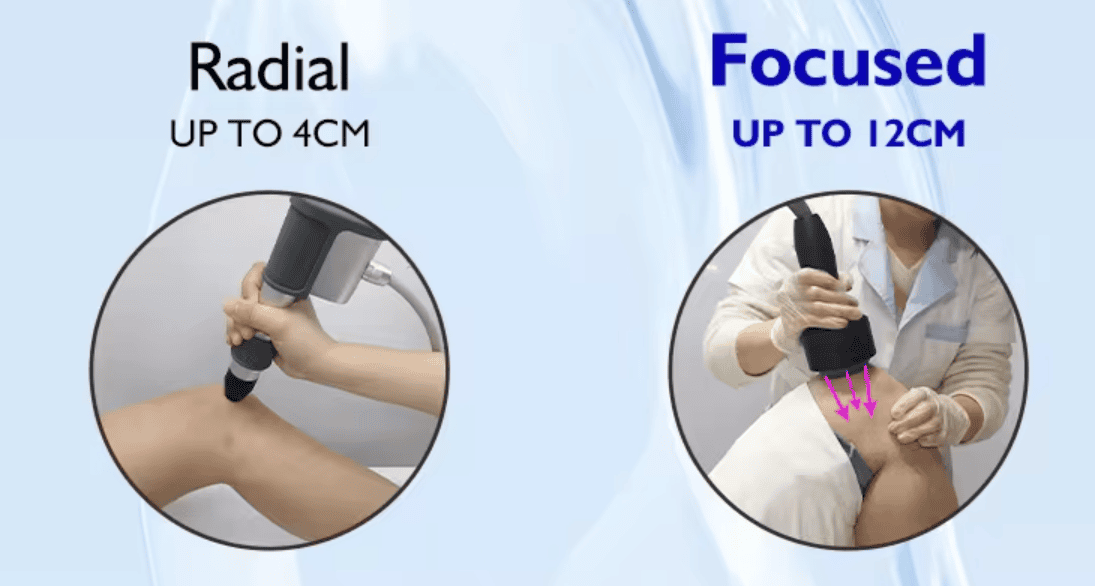 Aurora Newmarket Richmond Hill Focused Shockwave Therapy