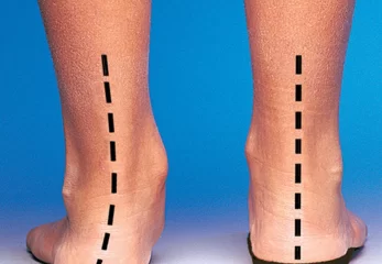 Custom Bracing & Orthotics